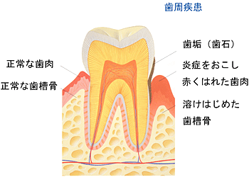 歯周病について