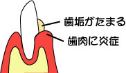 歯周病の進行1