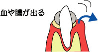 歯周病の進行3