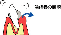 歯周病の進行4